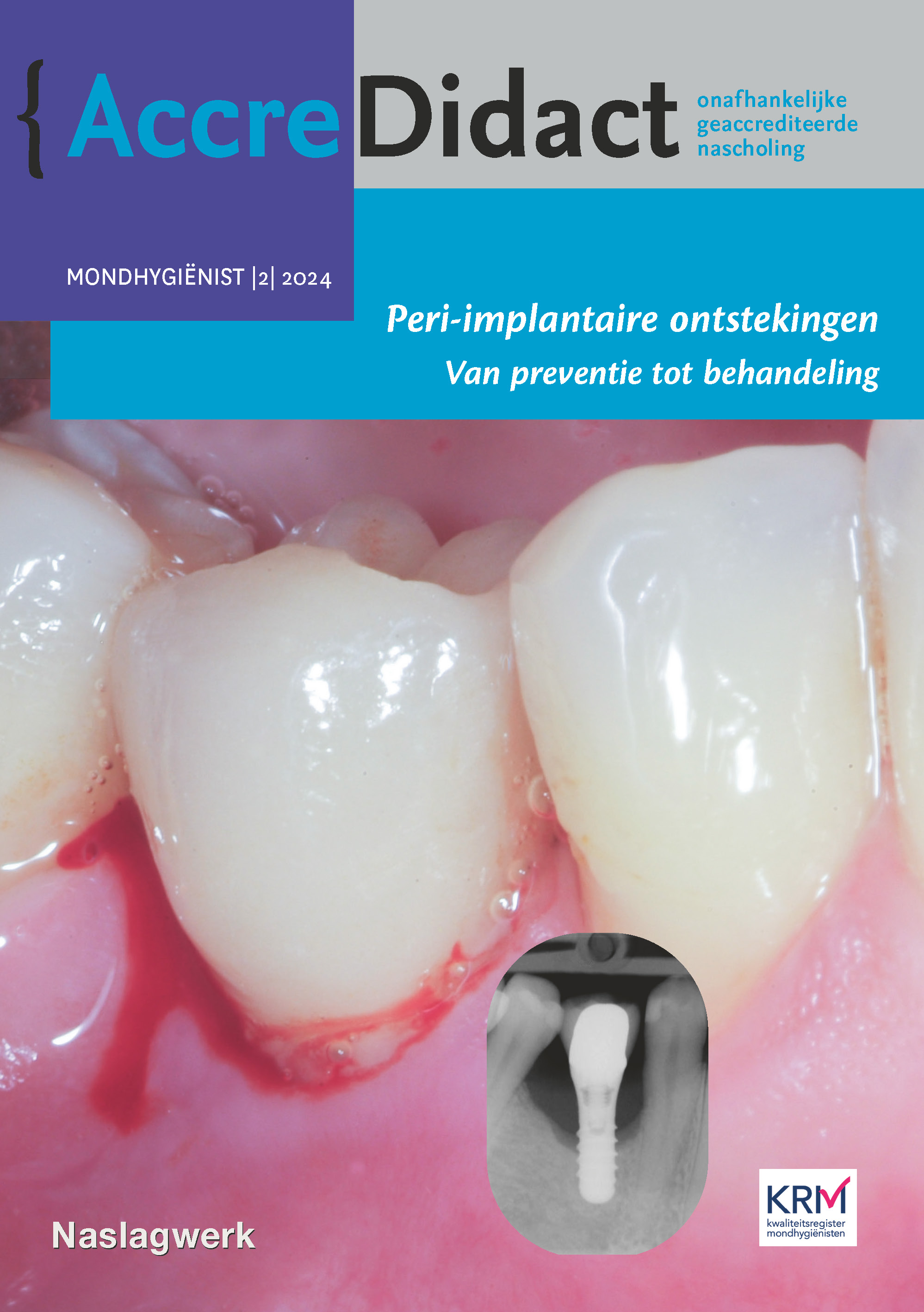 Peri-implantaire ontstekingen Van preventie tot behandeling
